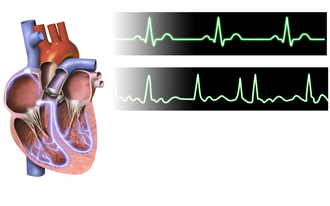 Illustration of the heart with normal sinus rhythm and atrial fibrillation ECG waveforms; educational image, not an IDEAL-AF trial participant or procedure image.