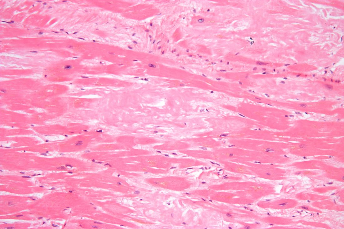 High-magnification H&E micrograph showing cardiac amyloid deposition; illustrative pathology image, not a CARDIO-TTRansform study specimen.