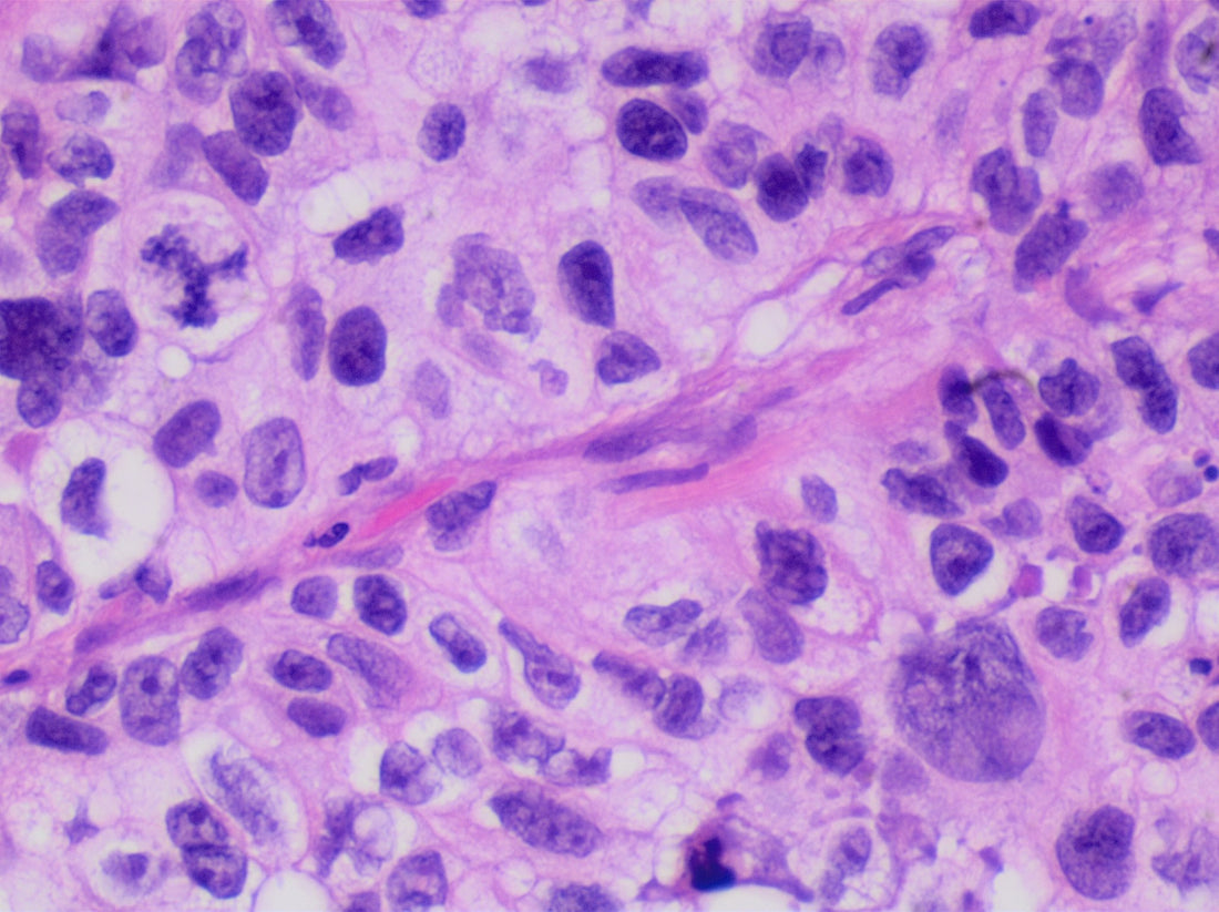 Histopathology of poorly differentiated lung adenocarcinoma; illustrative image, not a TOP trial participant or specimen and not specific to EGFR/TP53-mutant NSCLC.