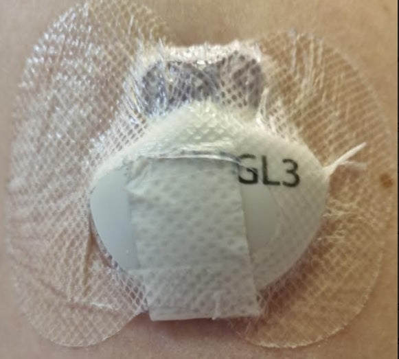 Medtronic Guardian Sensor 3 glucose sensor and Guardian Link 3 transmitter attached to skin, illustrating the CGM system used in the SIGNAL trial.