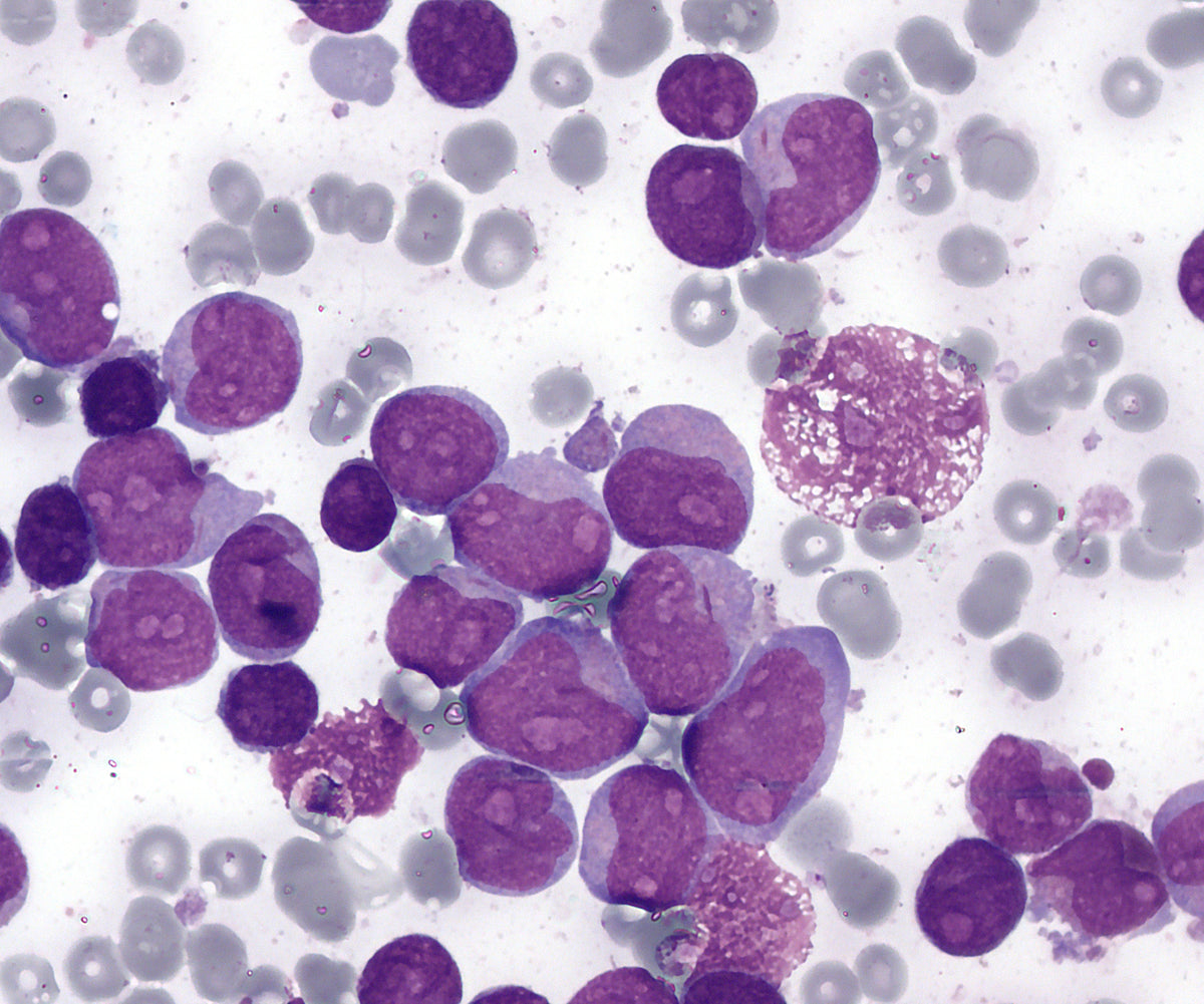 Bone marrow smear showing acute myeloid leukemia cells; illustrative microscopy image, not a PARADIGM trial participant or study specimen.