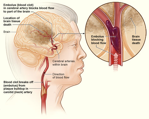 NIH illustration showing an embolic clot blocking a cerebral artery and causing ischemic stroke; illustrative image, not a LAIS trial participant or scan.