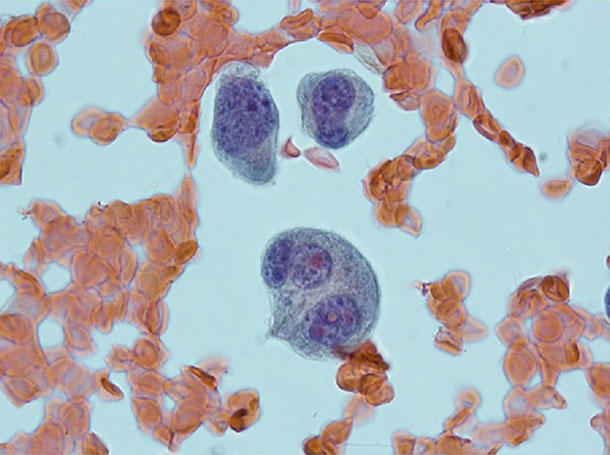 Microscopic view of smoldering myeloma cells, shown in purple, among surrounding blood cells; featured for Soleil Research coverage of the ImmunoPRISM teclistamab phase 2 trial.